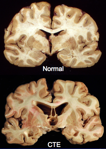 normal-and-cte-brains.jpg