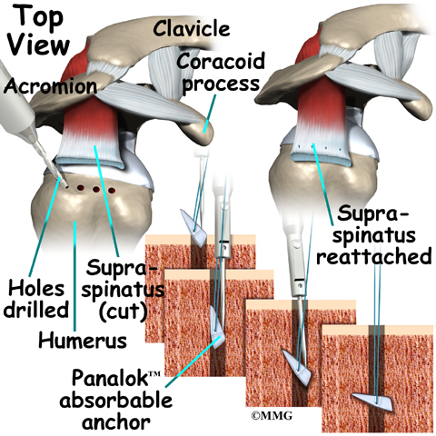 shoulder_rotator_cuff_treatment06.jpg