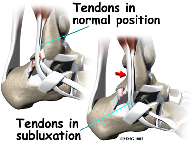 ankle_peroneal_sublux_causes02.jpg