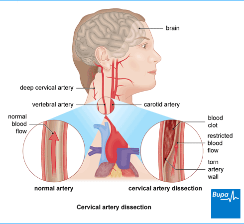 Cervical-artery-dissection.ashx