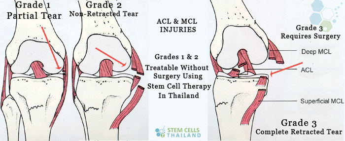 grade-1-2-retractable-acl-mcl-tear-stem-cell-therapy.jpg