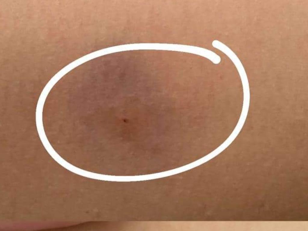 A photograph of the 20-year-old woman’s thigh appearing to show a needle stick and bruising after she quickly fell ill at King Street Hotel. Photo: Supplied.