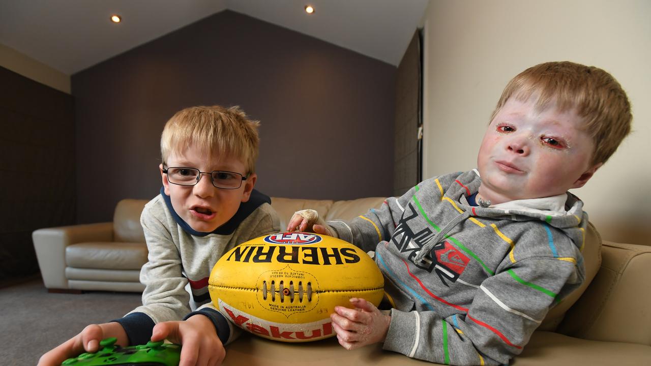 Miller and Harrison Pennicott, pictured in September 2018, on the eve of Harrison entering the Royal Children’s Hospital for intensive treatment for scleroderma. Picture: James Ross.