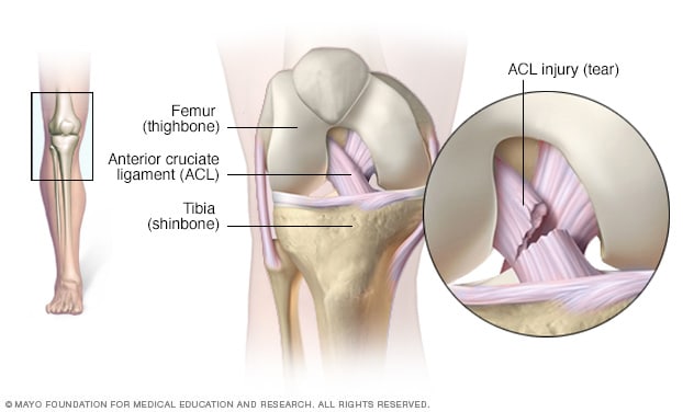 ds00555_ds00662_im02520_mcdc7_acl_injurythu_jpg.jpg