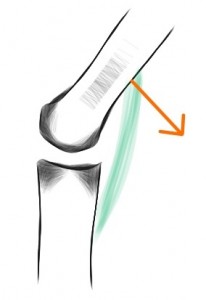 Without an ACL: the femur falls back when trying to bend the knee